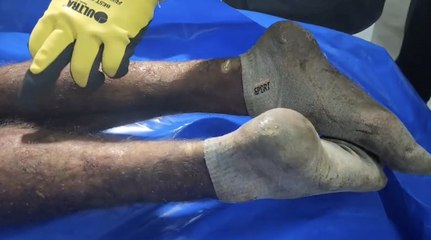 Quemaduras, fracturas y sogas al cuello en los cuerpos palestinos entregados por Israel