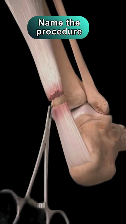 What is this procedure???