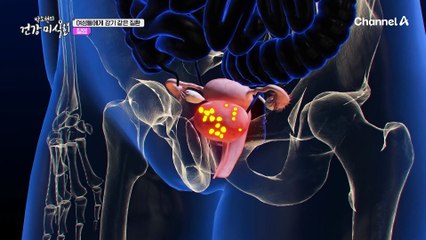 우리 몸에도 곰팡이가 있다?! 중년 여성을 괴롭히는 3대 여성 질환