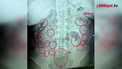 Aksaray'da akılalmaz olay! Midesinden 433 gram metamfetamin çıktı