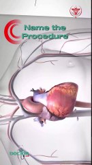 Name the procedure...