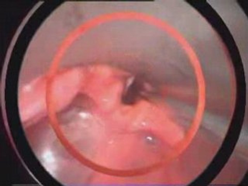 Laryngoscopie en suspension