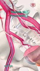 Name the procedure..