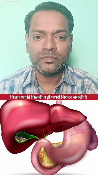 पित्ताशय की कितनी बड़ी पथरी निकल सकती है ।