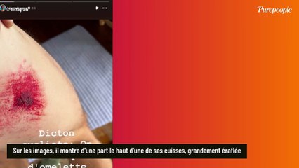 Bixente Lizarazu partage des photos de son corps, très marqué après une sortie à vélo qui a tourné court