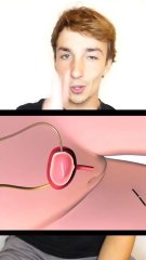 Chirurgie calculs rénaux