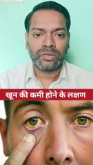 खून की कमी होने के लक्षण ।