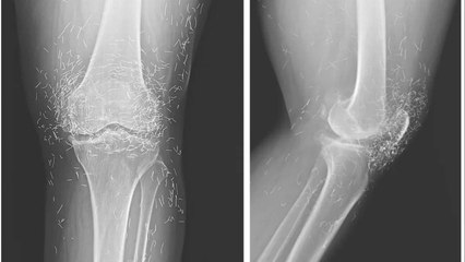 X-Ray Shows Hundreds of Gold Needles Embedded in Woman’s Knees