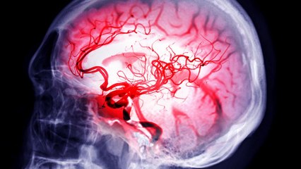 Early Warning Signs of an Aneurysm You Shouldn’t Ignore