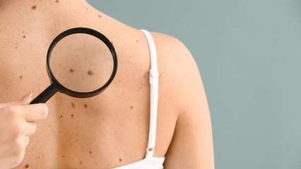 5 Key Facts About Skin Cancer Everyone Should Know