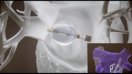 Un "palloncino" per il trattamento della fibrillazione atriale