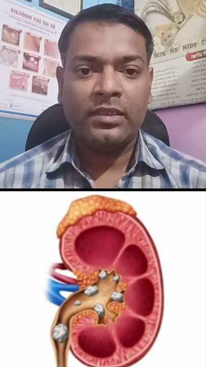 गुर्दे की पथरी का इलाज ।