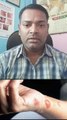 जले हुए शरीर का इलाज ।