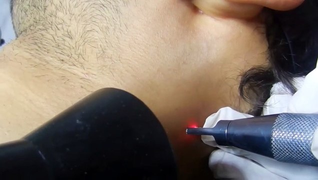 Warts and Skin Tags Treatment in Delhi – Safe Removal at Derma Station