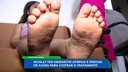 Como Ajudar Nicole: Campanha Solidária para Tratamento de Dermatite Alérgica e Atópica em Criança de 9 anos em Bezerros