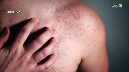 Indagan primera muerte por sarampión en Jalisco; sería una bebé de 11 meses