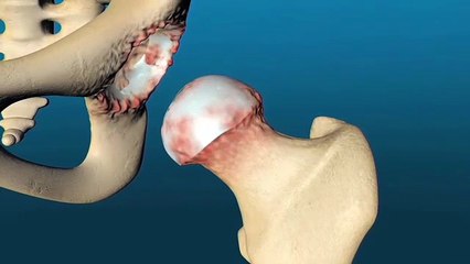 Total Hip Replacement Surgery in Delhi – Comprehensive Joint Restoration Solutions