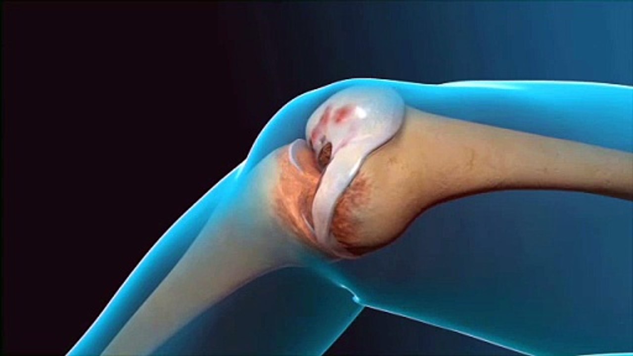 Advanced Total Knee Replacement Surgery in Delhi – Trusted Orthopedic Specialists