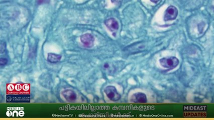 'ലക്ഷണങ്ങൾ കണ്ടാൽ ഉടൻ തന്നെ ചികിത്സ തേടണം' മങ്കിപോക്‌സിൽ ജാഗ്രത