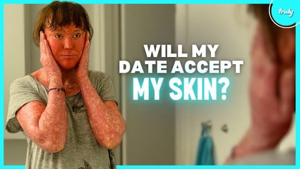 People Avoid Me Because Of My Skin - Will My Blind Date? | BORN DIFFERENT