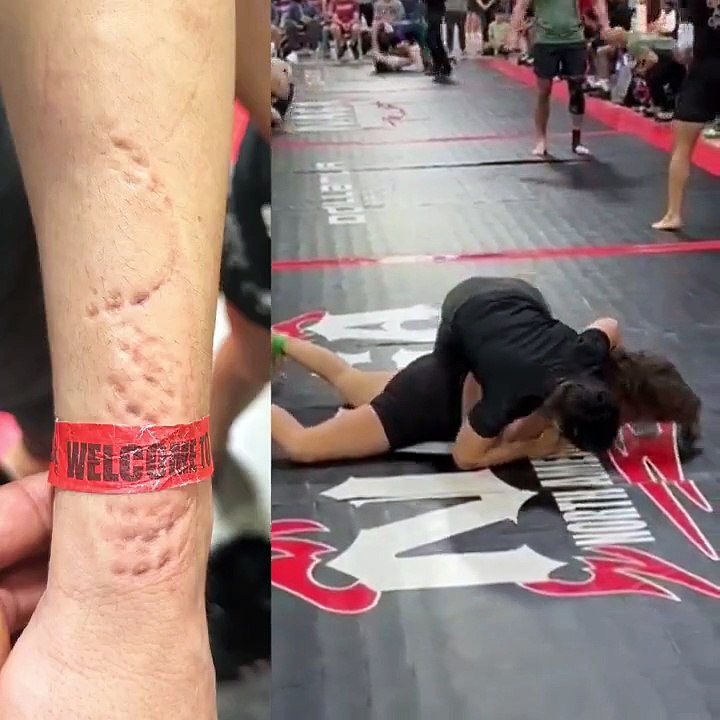Luchadora de jiu-jitsu revela brutal mordida de su oponente en pleno combate (VIDEO)