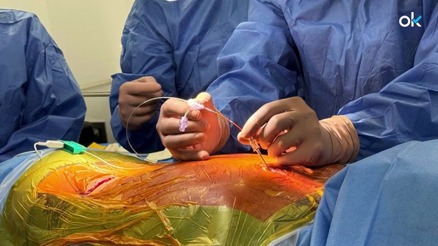 La neuroestimulación permite recuperar la movilidad en un paciente con síndrome de dolor regional complejo