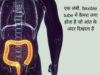 Understanding Colonoscopy: A Key Test for Colon Cancer Prevention