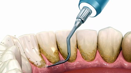 What Happens if You Skip Dental Scaling and Cleaning? | Best Dental Clinic in Bhiwani | Triveni Dental