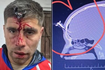 Violencia en el fútbol femenino: le clavan una llave de coche en la cabeza al padre de una jugadora