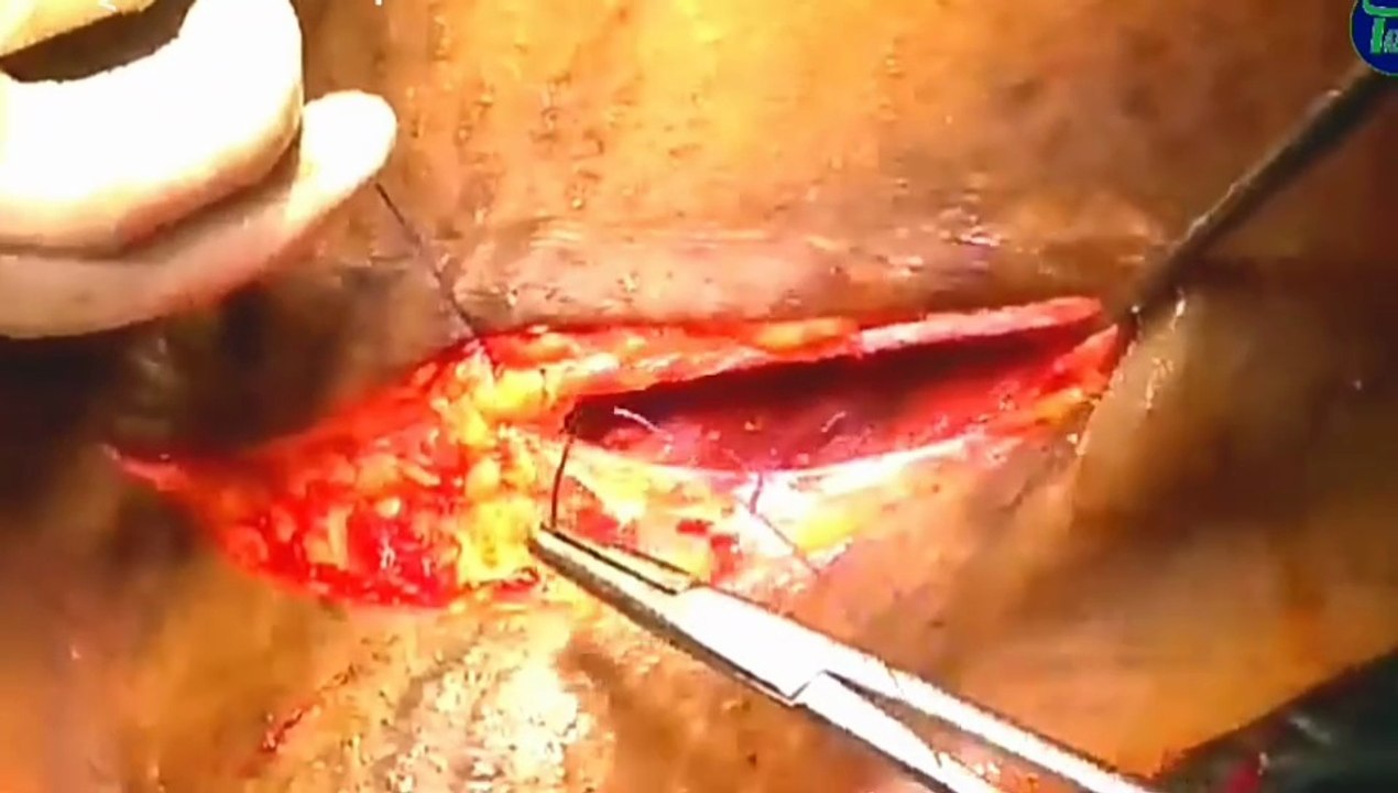 Caesarean Delivery Live | সিজারিয়ান ডেলিভারি লাইভ দৃশ্য