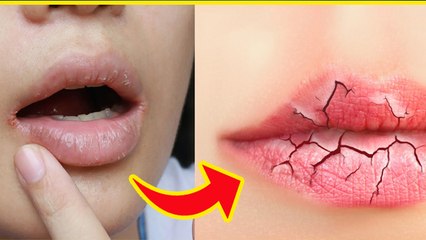 Cracked Lips Corner: होंठों के किनारे फटने का इलाज, जानें वजह, विटामिन की कमी और डाइट | Boldsky