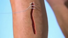 Next-Gen Wound Stitch Device 😲