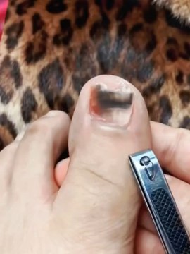 Toenail Fungus Treatment Extra StrengthProduct link👇India :- amzn.to/3LTKnL4Other Country :- amzn.to/43HvYb8#gadgets #amazon #amazongadget