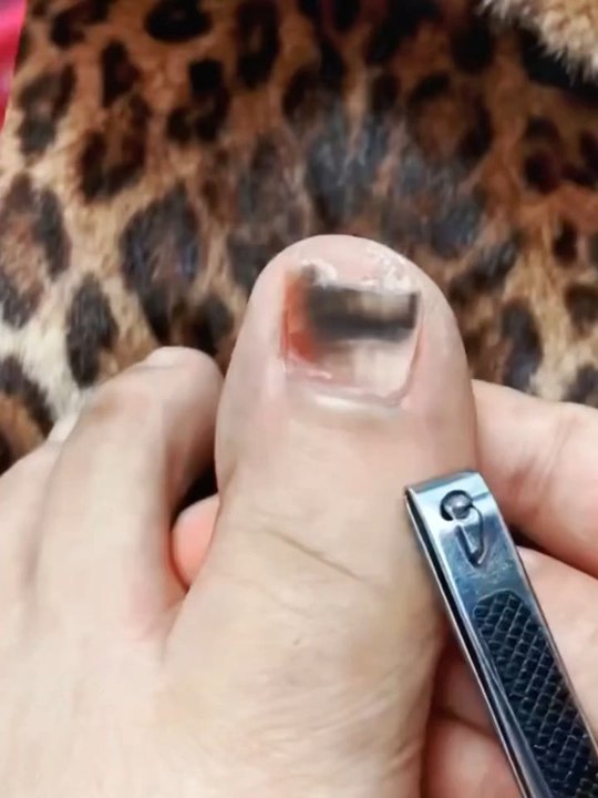 Toenail Fungus Treatment Extra StrengthProduct link👇India :- https://amzn.to/3LTKnL4Other Country :- https://amzn.to/43HvYb8#gadgets #amazon #amazongadget