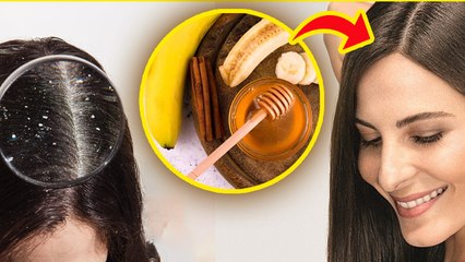 Dandruff Hair Mask: डैंड्रफ को हटाने के घरेलू उपाय | Winter Dandruff Treatment At Home | Boldsky