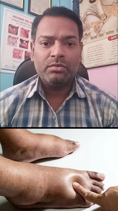 सूजन ।