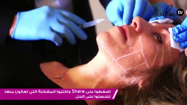 شد الوجه من دون جراحة للمرة الأولى مع الدكتور نادر صعب