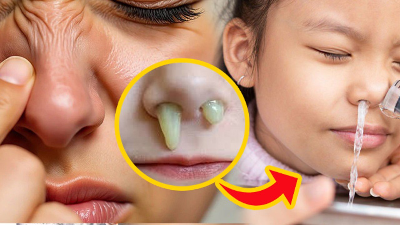 Nose Cleaning Home Remedy: नाक की गंदगी को कैसे साफ करें?, Ghar Par Naak Saaf Karne Ka Tarika...