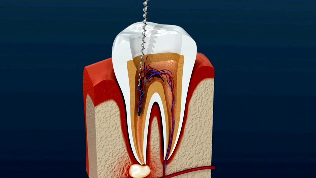 Is crown necessary after root canal treatment?...