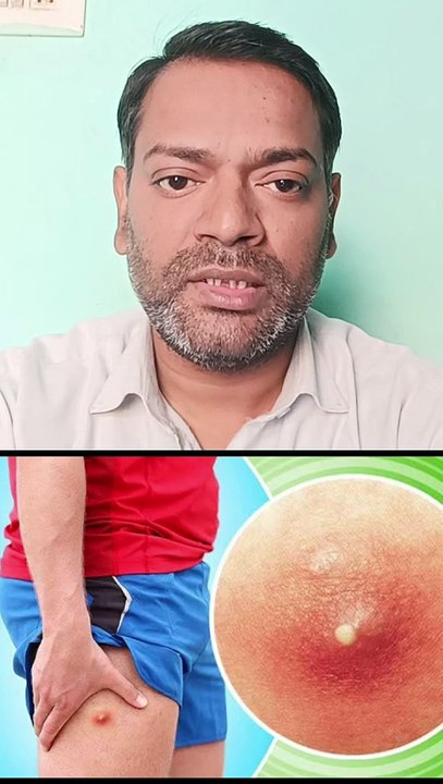 फोड़ा,फुंसी,बालतोड़