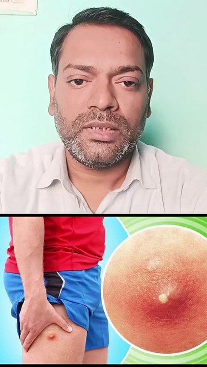 फोड़ा,फुंसी,बालतोड़
