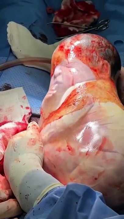 Bebê nasce empelicada em parto raro no Meio-Oeste de SC e surpreende equipe médica