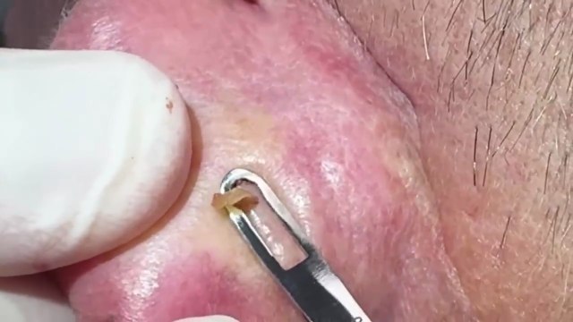 Deep embedded ear blackheads_ Watch me clear the pores and remove follicular cysts. Your favorite