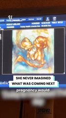 Doctors warned my conjoined twins wouldn’t survive... 💔