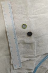 बटन सेल निगल गया पांच माह का बच्चा, अहमदाबाद सिविल अस्पताल के चिकित्सकों ने बचाया जीवन