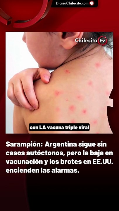 Sarampión: Argentina sigue sin casos autóctonos, pero la baja en vacunación y los brotes en EE.UU. encienden las alarmas.