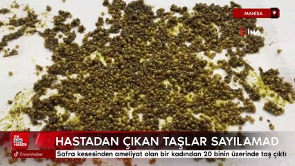 Manisa'da ameliyat olan kadının safra kesesinden 20 bin taş çıktı