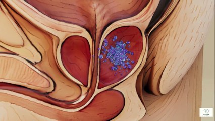 “Prostate vs. Colon vs. Lung Cancer What Seniors Need to Know About Treatability—A Calm, Clear Guide”