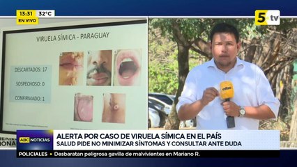 Alerta por caso de viruela símica en el país