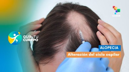 Alopecia: Alteración del ciclo capilar